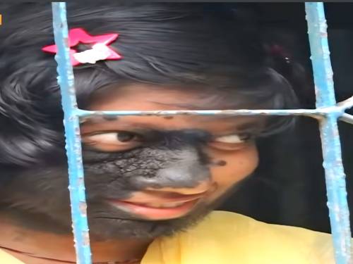 A Rare Disease of Julekha